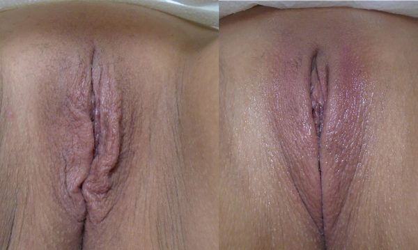bloomobgyn-thermiva-vaginal-rejuvenation-1