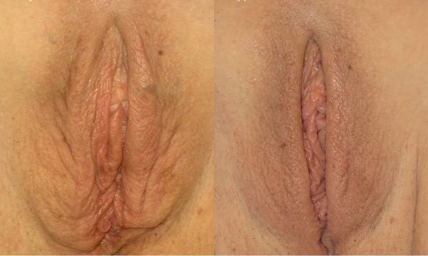 bloomobgyn-thermiva-vaginal-rejuvenation-2
