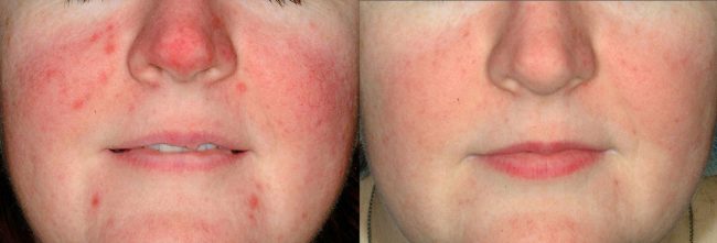 bloomobgyn-rosacea-before-after-1